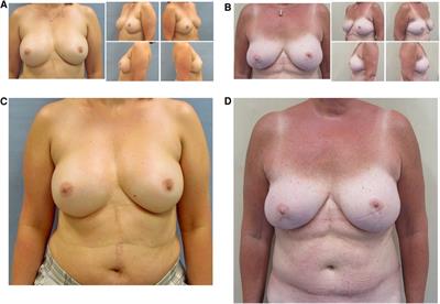 Autologous vs. implant-based breast reconstruction after skin- and nipple-sparing mastectomy—A deeper insight considering surgical and patient-reported outcomes